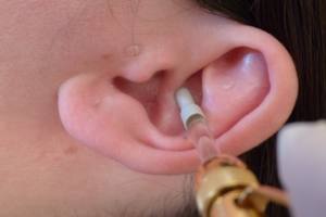 Cryo Auriculothérapie