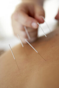 Acupuncture traditionnelle