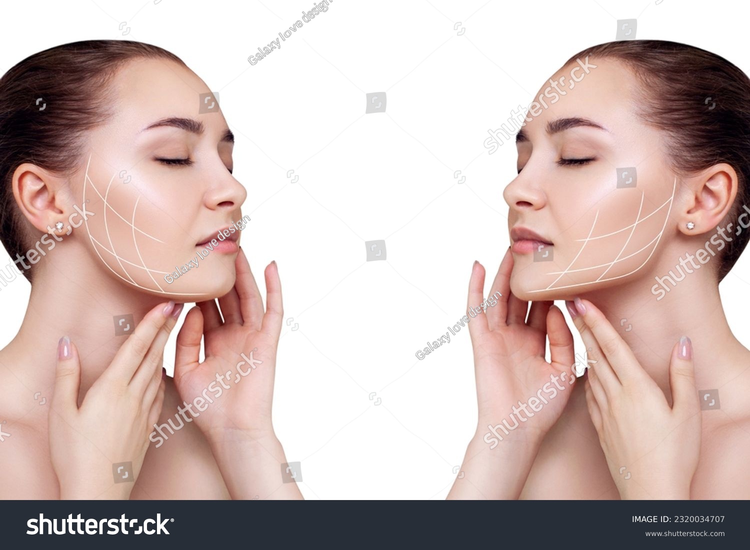 les fils tenseurs corrigent le relâchement de l'ovale du visage à la manière d'un lifting